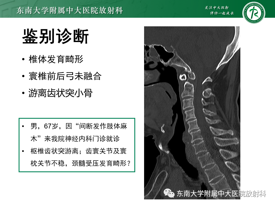 影像PPT - 【PPT】上颈椎骨折影像学评估-34 影像PPT - 【PPT】上颈椎骨折影像学评估-34