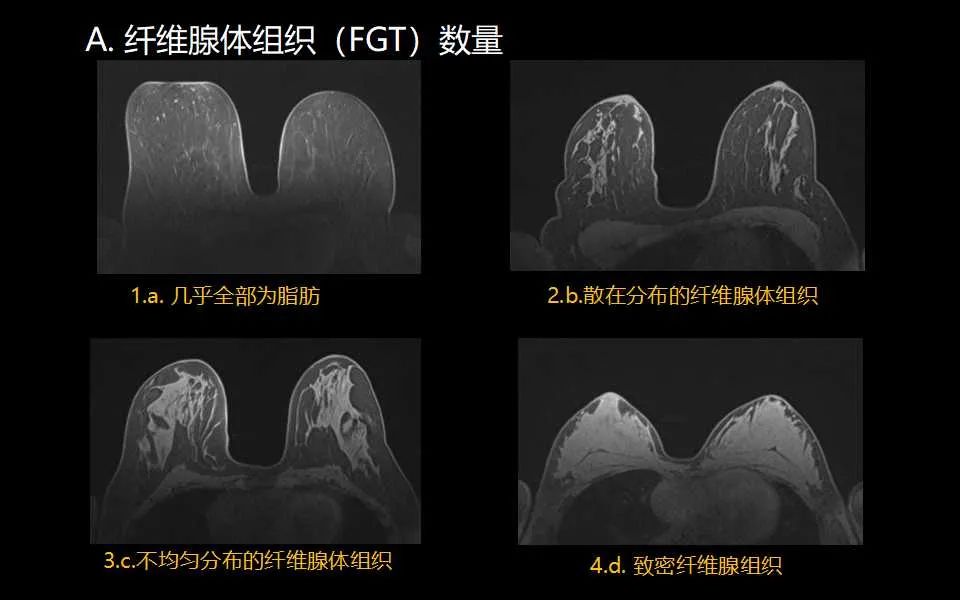 影像PPT - 【PPT】解读乳腺磁共振成像：ACR BI-RADS MRI报告词汇及图片回顾-8