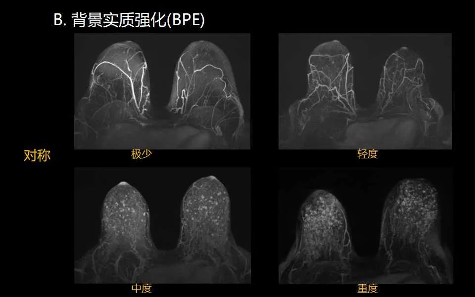 影像PPT - 【PPT】解读乳腺磁共振成像：ACR BI-RADS MRI报告词汇及图片回顾-10