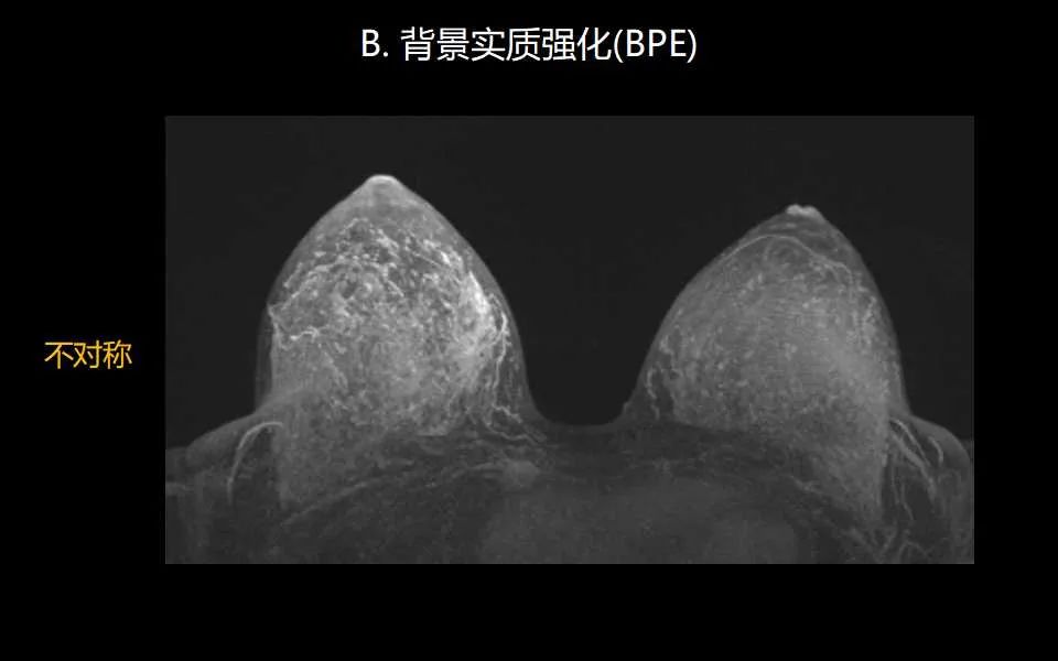 影像PPT - 【PPT】解读乳腺磁共振成像：ACR BI-RADS MRI报告词汇及图片回顾-12
