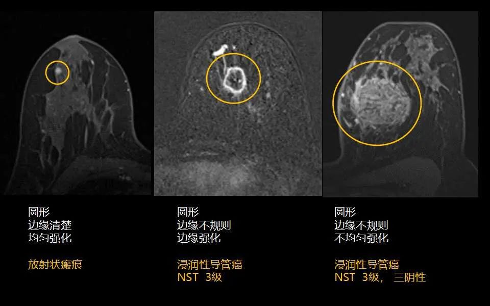 影像PPT - 【PPT】解读乳腺磁共振成像：ACR BI-RADS MRI报告词汇及图片回顾-20