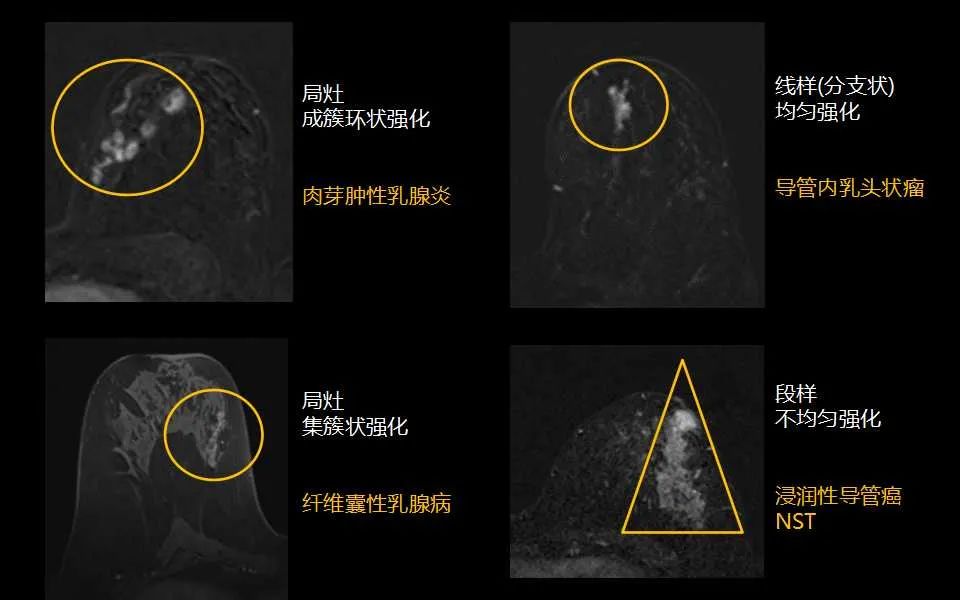 影像PPT - 【PPT】解读乳腺磁共振成像：ACR BI-RADS MRI报告词汇及图片回顾-26