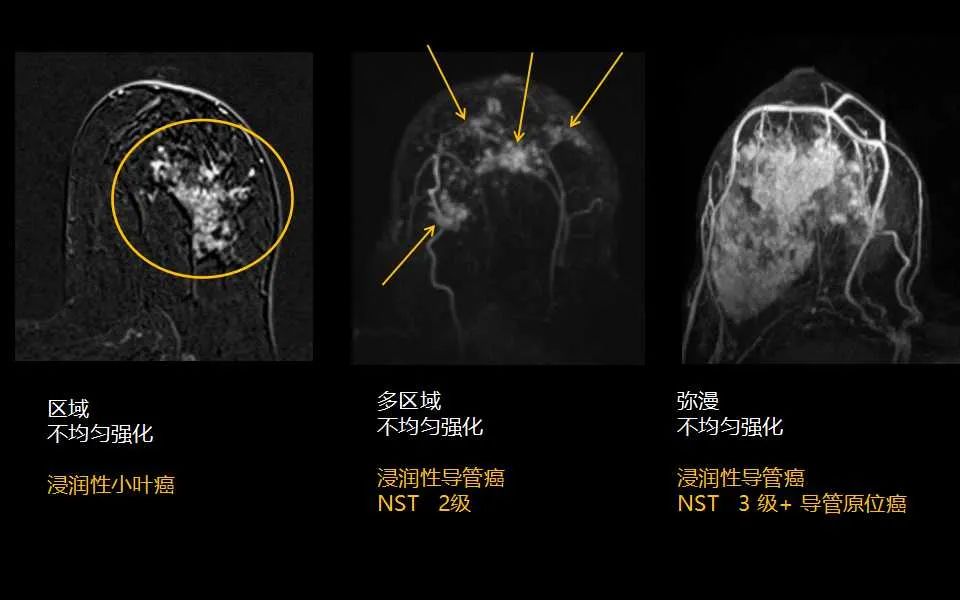 影像PPT - 【PPT】解读乳腺磁共振成像：ACR BI-RADS MRI报告词汇及图片回顾-28
