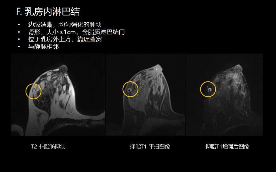 影像PPT - 【PPT】解读乳腺磁共振成像：ACR BI-RADS MRI报告词汇及图片回顾-30