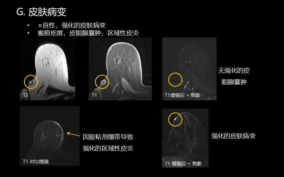 影像PPT - 【PPT】解读乳腺磁共振成像：ACR BI-RADS MRI报告词汇及图片回顾-32