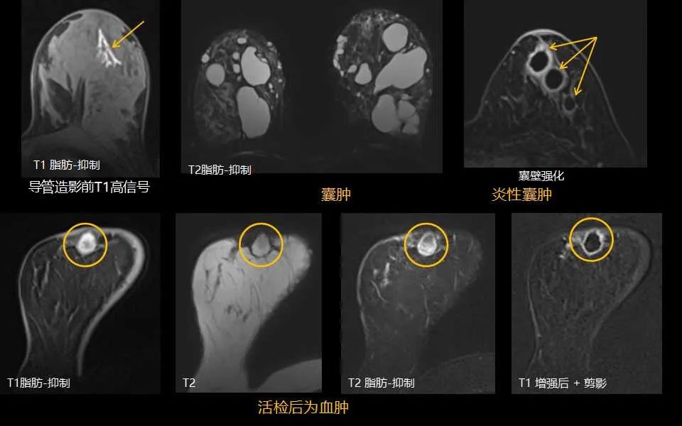 影像PPT - 【PPT】解读乳腺磁共振成像：ACR BI-RADS MRI报告词汇及图片回顾-36