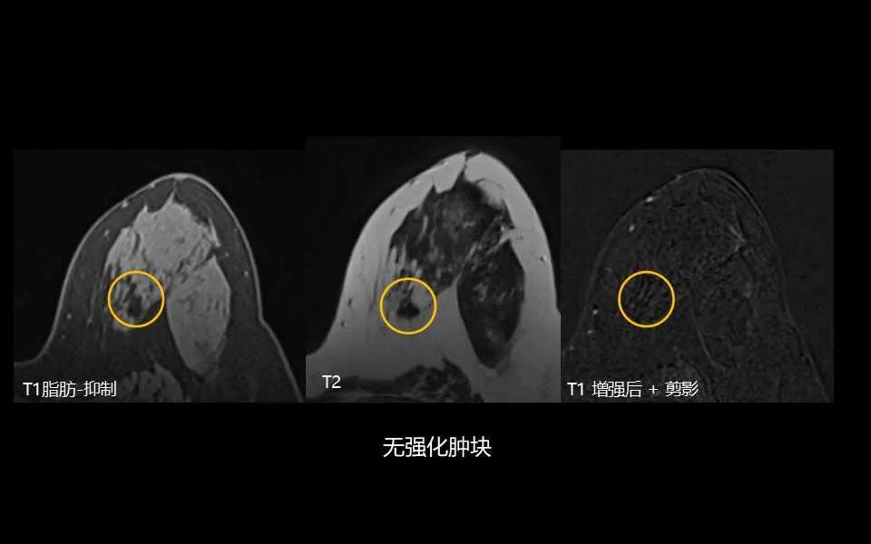 影像PPT - 【PPT】解读乳腺磁共振成像：ACR BI-RADS MRI报告词汇及图片回顾-40