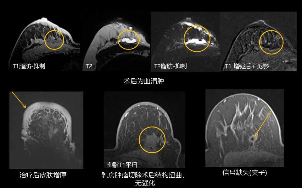影像PPT - 【PPT】解读乳腺磁共振成像：ACR BI-RADS MRI报告词汇及图片回顾-38
