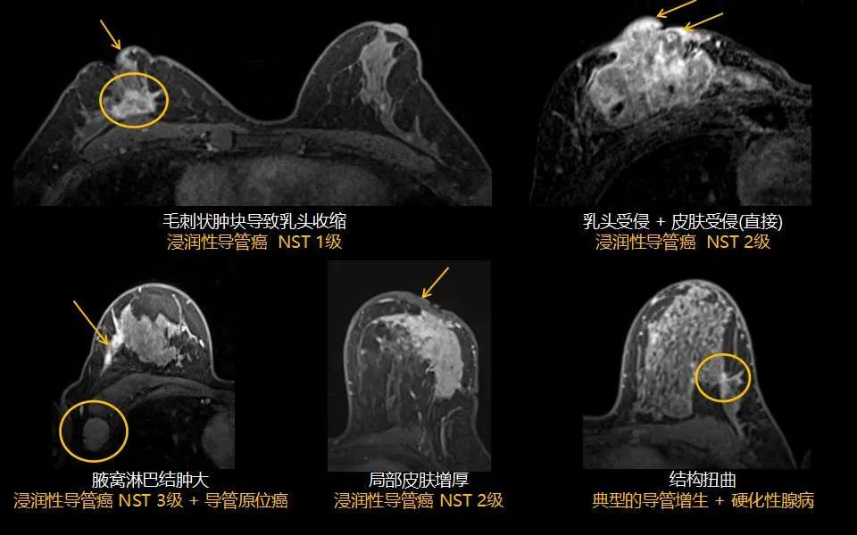 影像PPT - 【PPT】解读乳腺磁共振成像：ACR BI-RADS MRI报告词汇及图片回顾-44