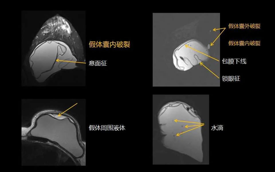 影像PPT - 【PPT】解读乳腺磁共振成像：ACR BI-RADS MRI报告词汇及图片回顾-58