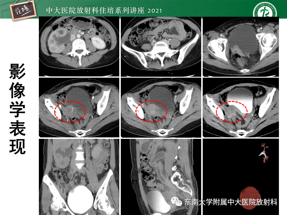 影像PPT - 【PPT】输尿管扩张性疾病的影像诊断-5
