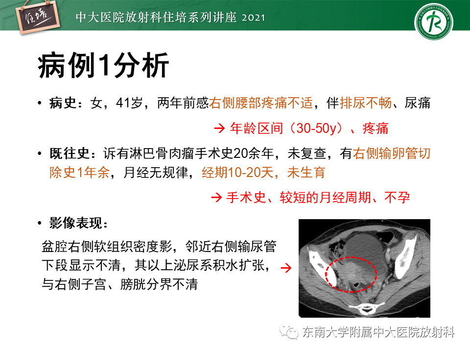 影像PPT - 【PPT】输尿管扩张性疾病的影像诊断-12
