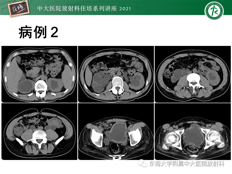 影像PPT - 【PPT】输尿管扩张性疾病的影像诊断-14