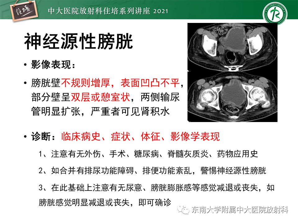 影像PPT - 【PPT】输尿管扩张性疾病的影像诊断-16