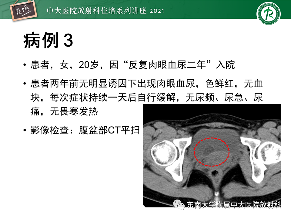 影像PPT - 【PPT】输尿管扩张性疾病的影像诊断-17