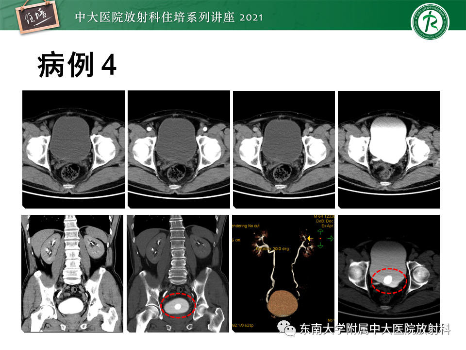 影像PPT - 【PPT】输尿管扩张性疾病的影像诊断-19