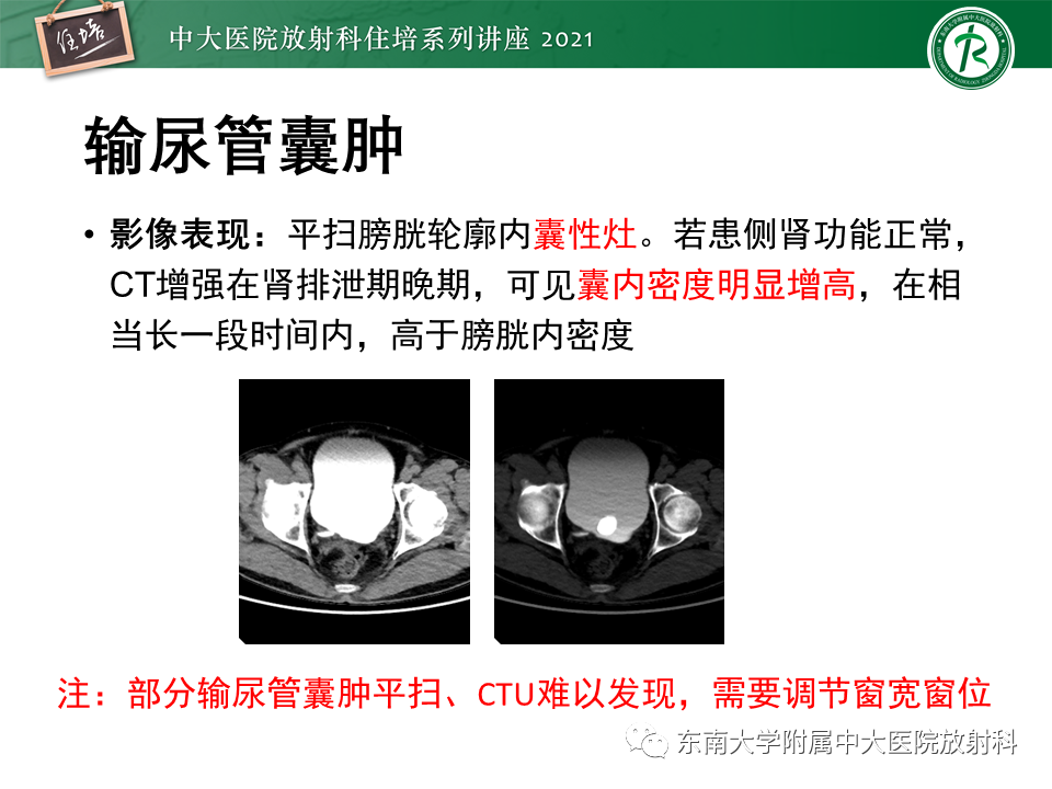 影像PPT - 【PPT】输尿管扩张性疾病的影像诊断-21