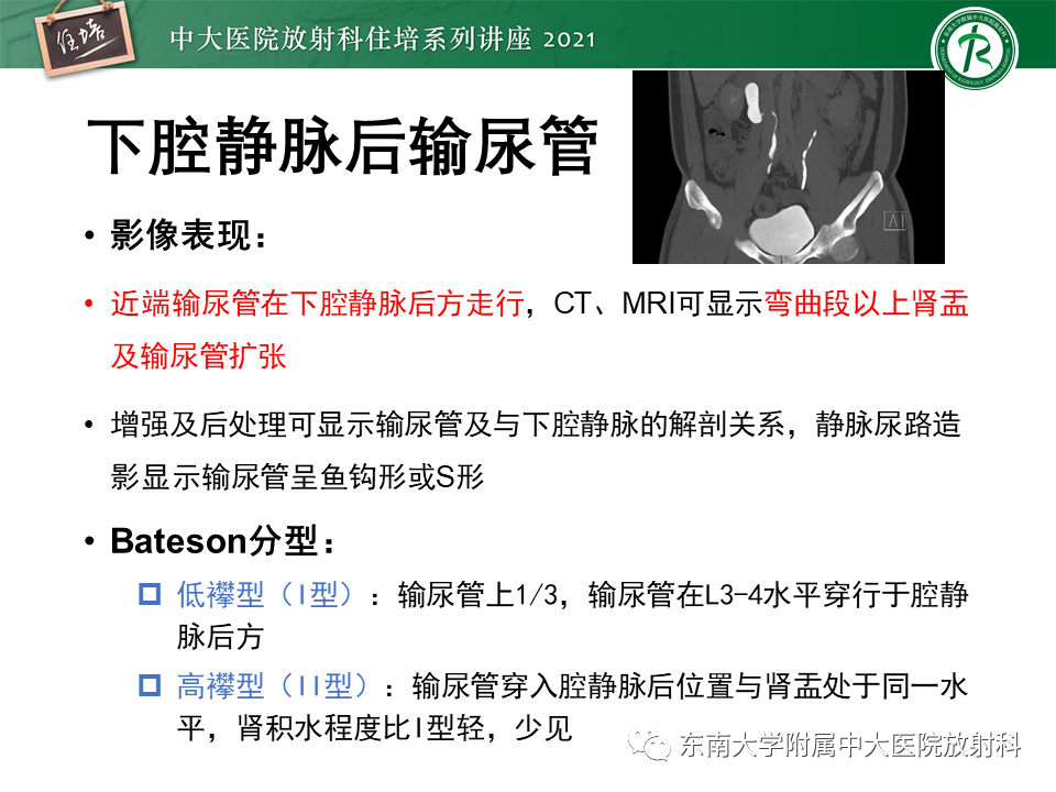 影像PPT - 【PPT】输尿管扩张性疾病的影像诊断-25