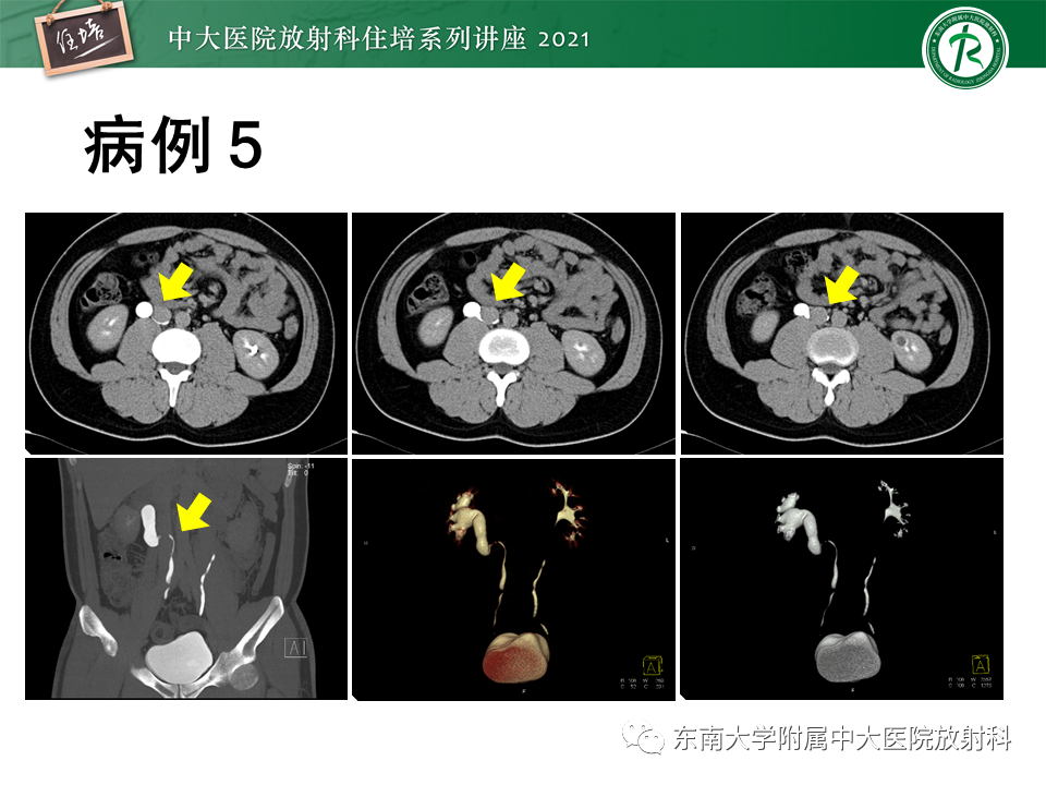 影像PPT - 【PPT】输尿管扩张性疾病的影像诊断-23