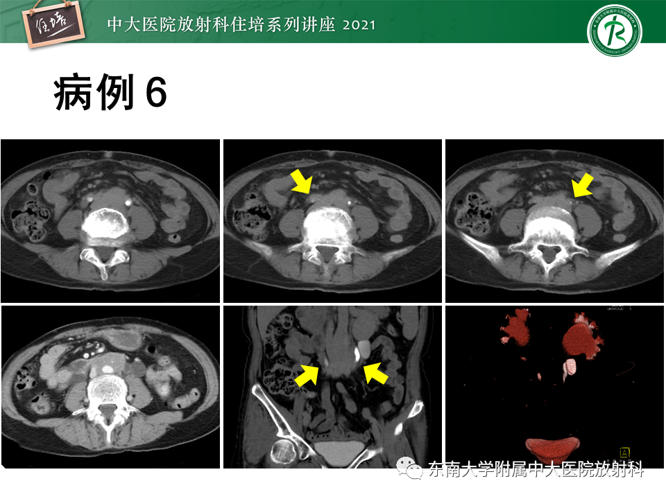 影像PPT - 【PPT】输尿管扩张性疾病的影像诊断-27