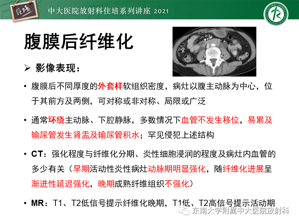 影像PPT - 【PPT】输尿管扩张性疾病的影像诊断-29