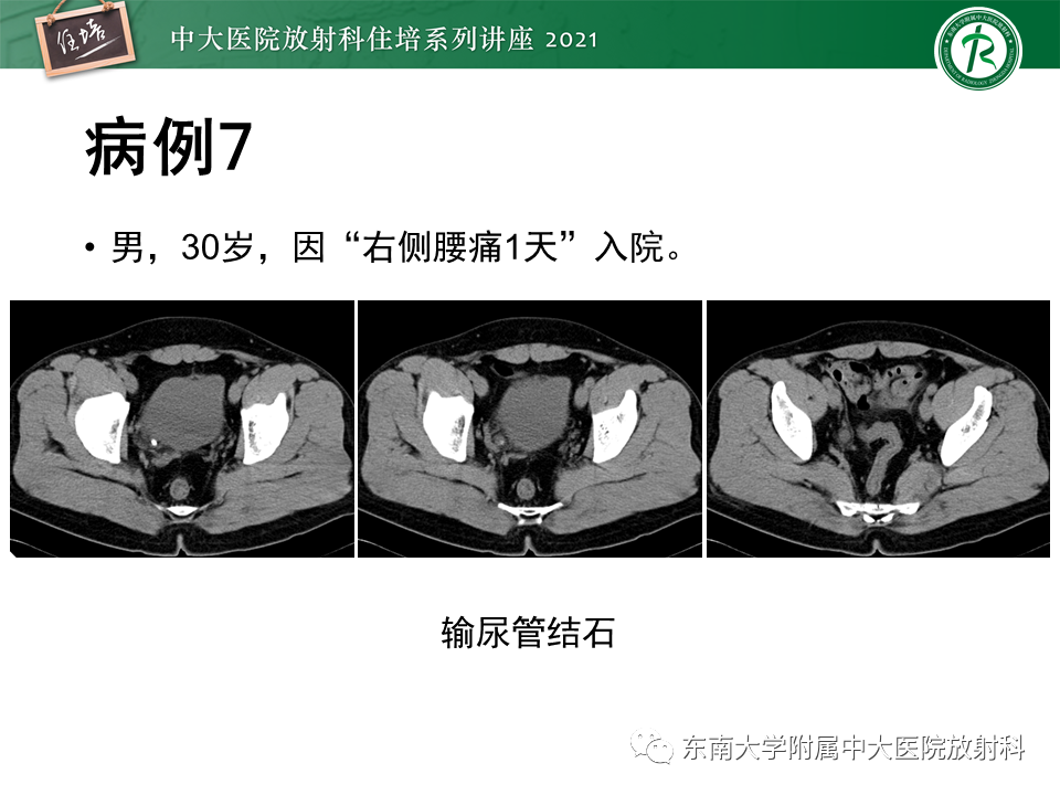 影像PPT - 【PPT】输尿管扩张性疾病的影像诊断-31