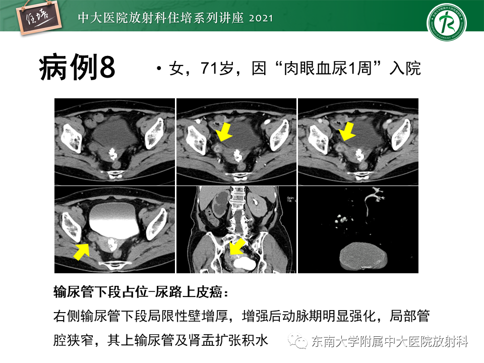 影像PPT - 【PPT】输尿管扩张性疾病的影像诊断-32
