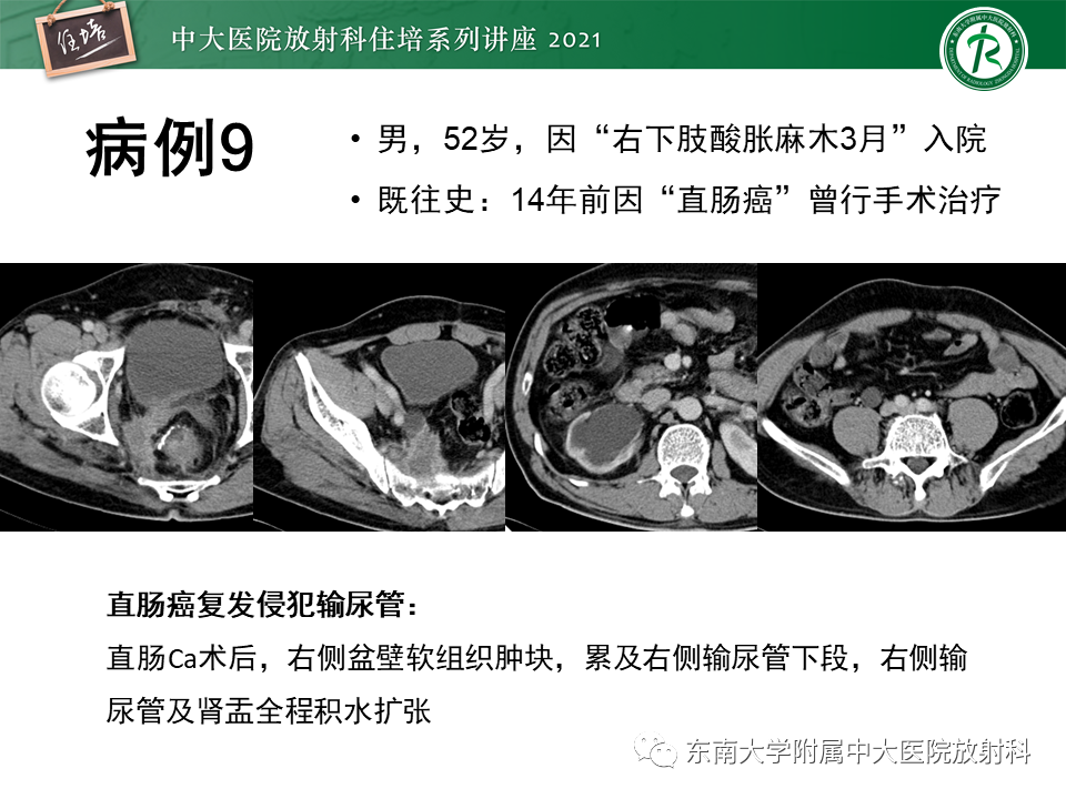 影像PPT - 【PPT】输尿管扩张性疾病的影像诊断-33