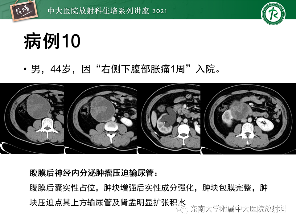 影像PPT - 【PPT】输尿管扩张性疾病的影像诊断-34