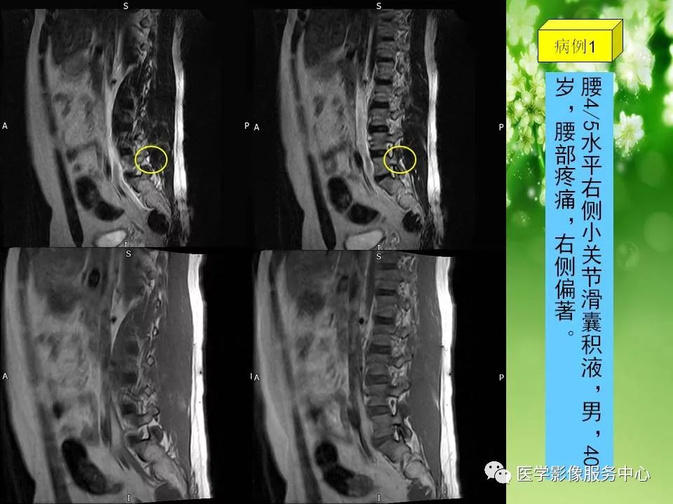 影像PPT - 【PPT】腰椎小关节滑囊积液-6