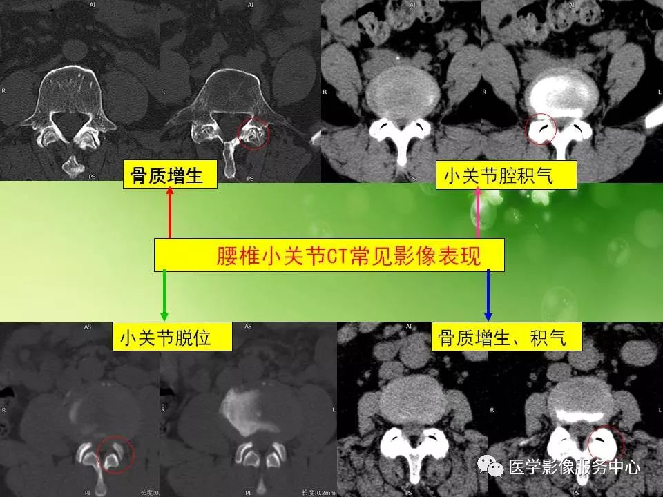 影像PPT - 【PPT】腰椎小关节滑囊积液-4