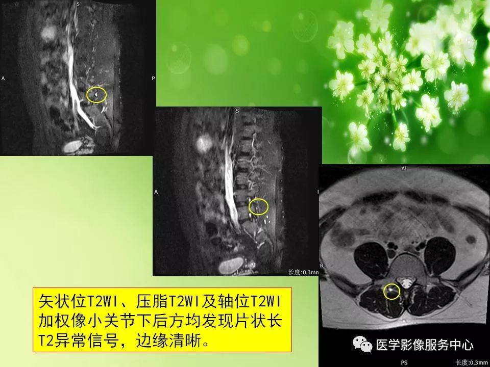 影像PPT - 【PPT】腰椎小关节滑囊积液-7