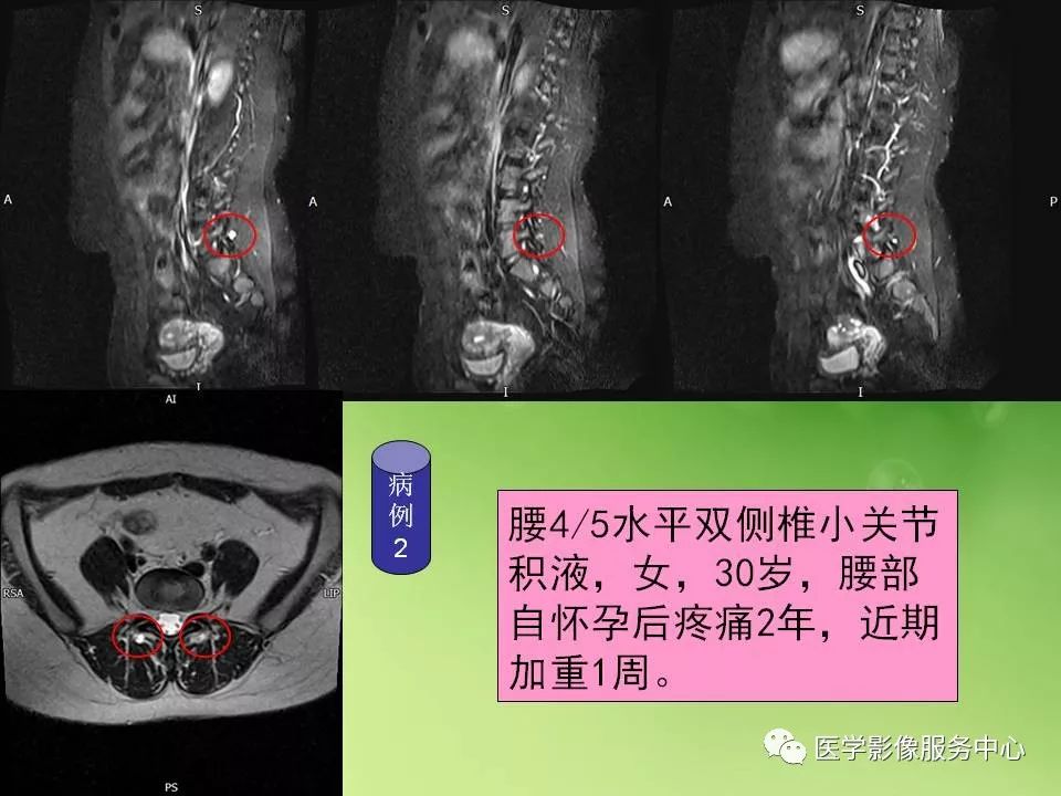 影像PPT - 【PPT】腰椎小关节滑囊积液-8