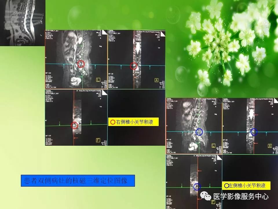 影像PPT - 【PPT】腰椎小关节滑囊积液-10