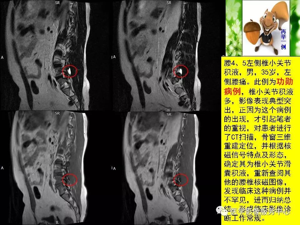 影像PPT - 【PPT】腰椎小关节滑囊积液-11
