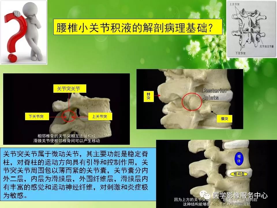 影像PPT - 【PPT】腰椎小关节滑囊积液-14