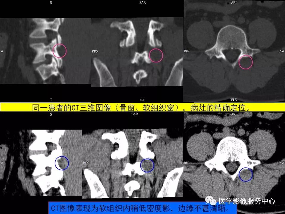 影像PPT - 【PPT】腰椎小关节滑囊积液-13