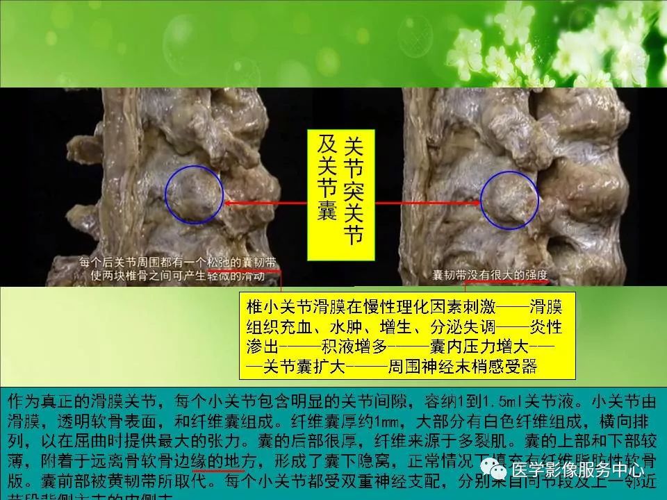 影像PPT - 【PPT】腰椎小关节滑囊积液-15