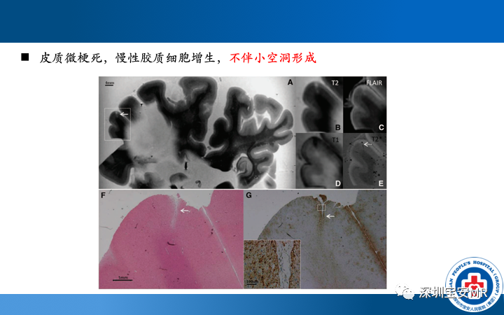 影像PPT - 【PPT】脑小血管病神经影像评估-15