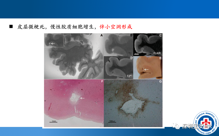 影像PPT - 【PPT】脑小血管病神经影像评估-16