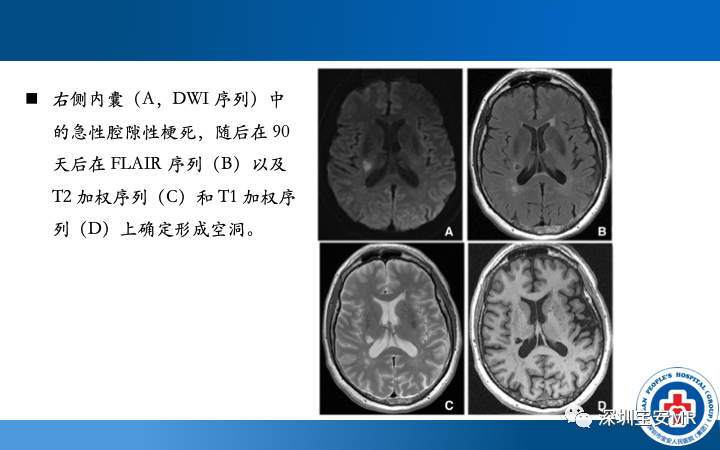 影像PPT - 【PPT】脑小血管病神经影像评估-18