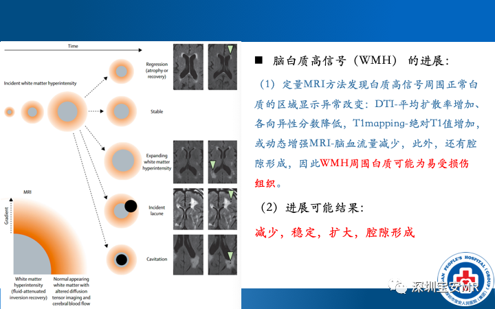 影像PPT - 【PPT】脑小血管病神经影像评估-22