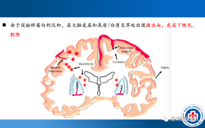 影像PPT - 【PPT】脑小血管病神经影像评估-25