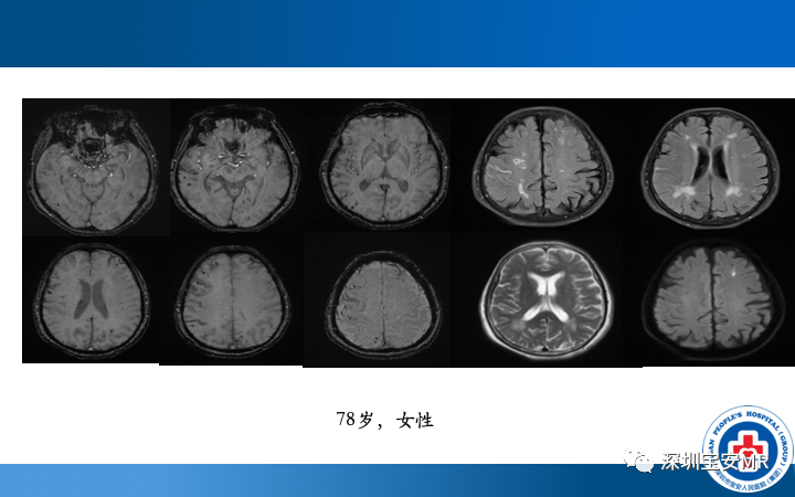 影像PPT - 【PPT】脑小血管病神经影像评估-26