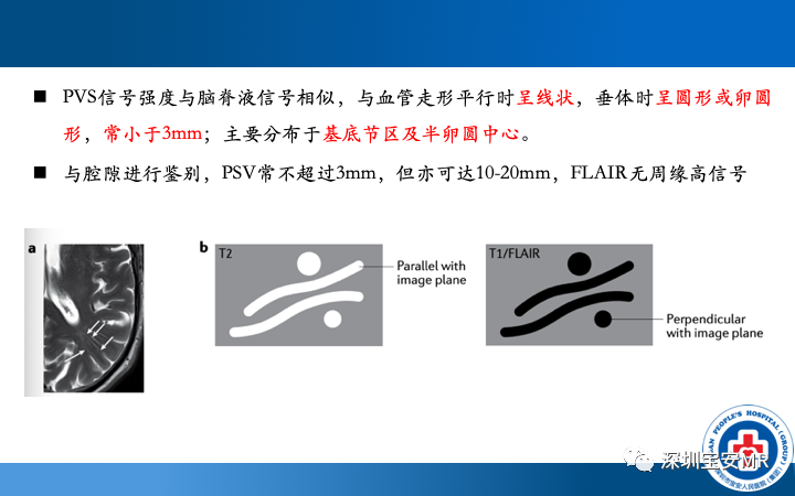 影像PPT - 【PPT】脑小血管病神经影像评估-28