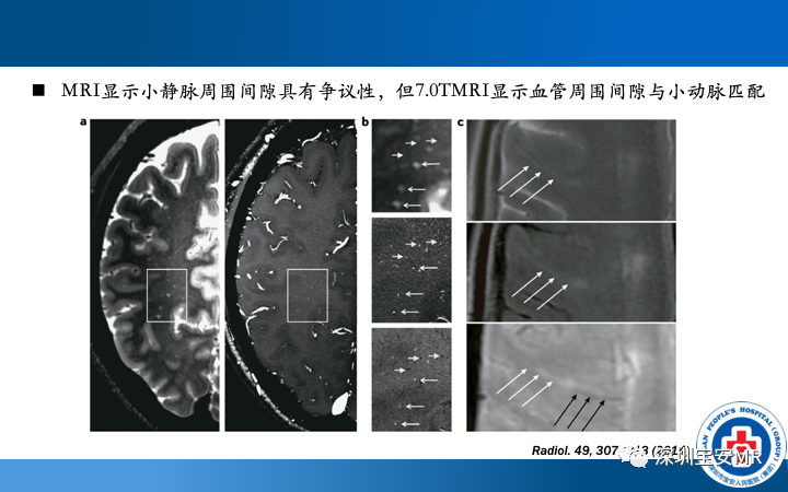 影像PPT - 【PPT】脑小血管病神经影像评估-29