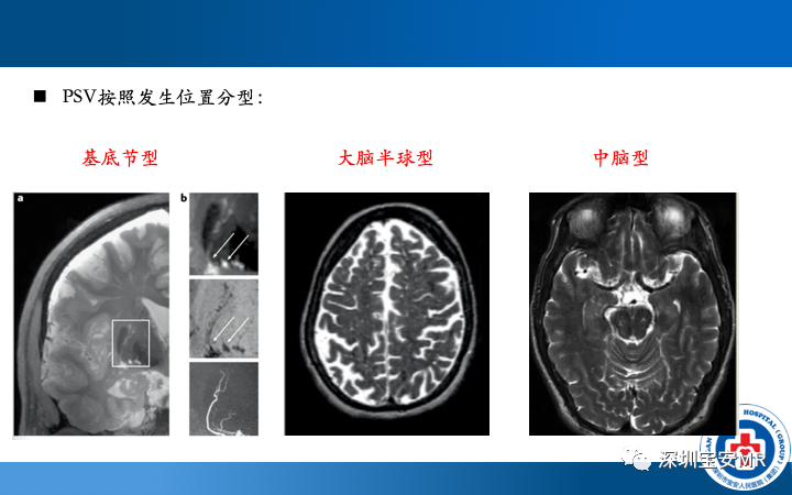 影像PPT - 【PPT】脑小血管病神经影像评估-30