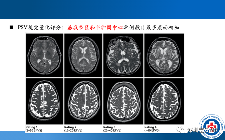 影像PPT - 【PPT】脑小血管病神经影像评估-31