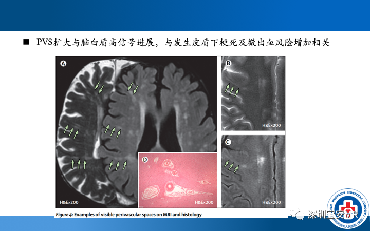 影像PPT - 【PPT】脑小血管病神经影像评估-32