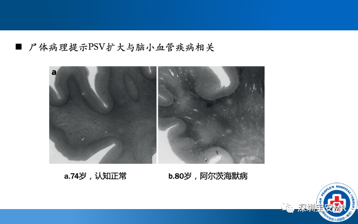 影像PPT - 【PPT】脑小血管病神经影像评估-33